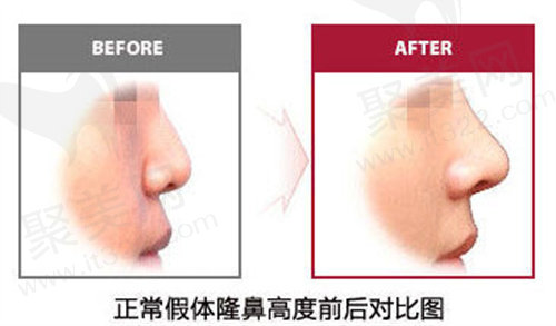 隆鼻手术