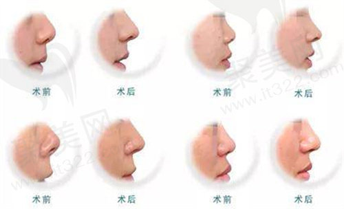 隆鼻手术