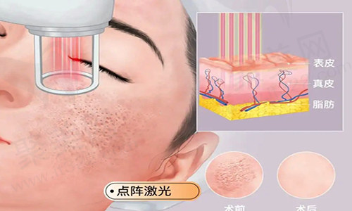 点阵激光