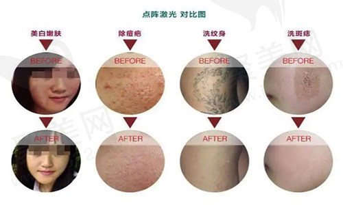 点阵激光