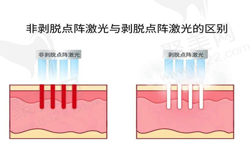 点阵激光