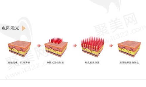 点阵激光