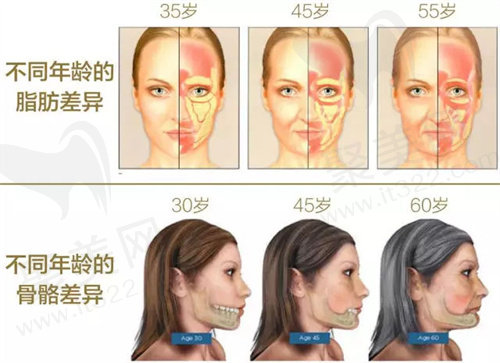 热玛吉