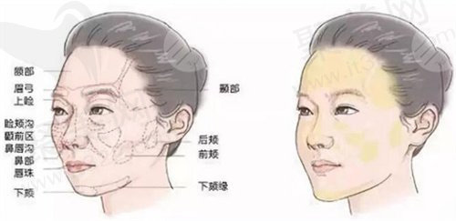 热玛吉