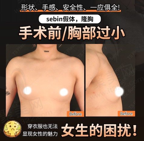 韩国TS整形外科医院假体隆胸手术前