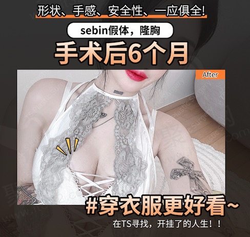 韩国TS整形外科医院假体隆胸手术后六个月