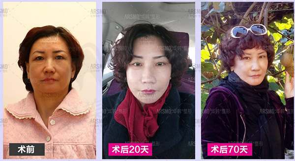 北京华韩柳民熙拉皮