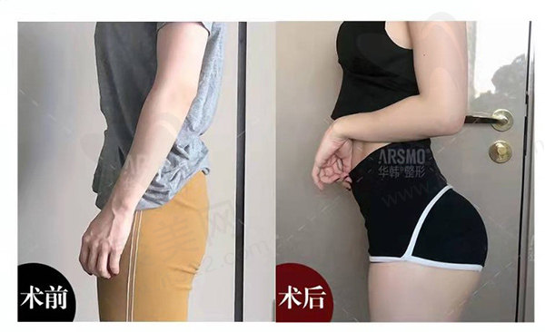 北京华韩余恩熙假体丰臀