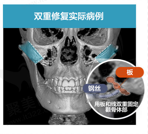 面部轮廓手术所用材质
