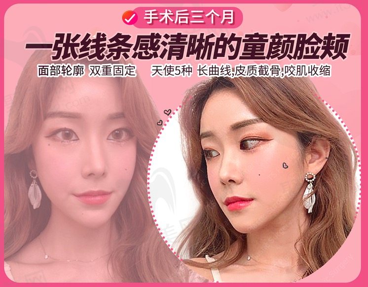 韩国ts面部轮廓双重固定手术后三个月