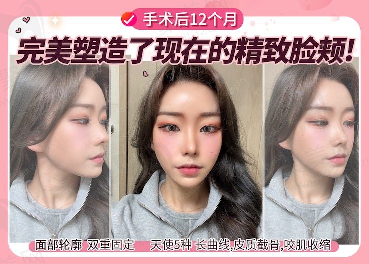 韩国ts面部轮廓双重固定手术一年后