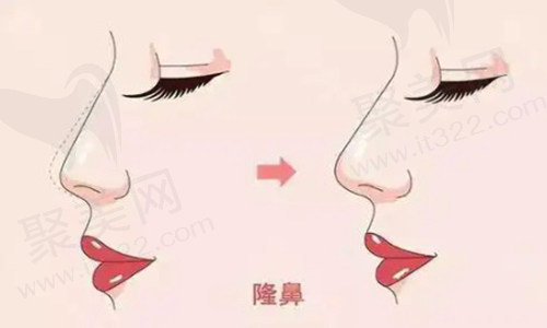 鼻部整形