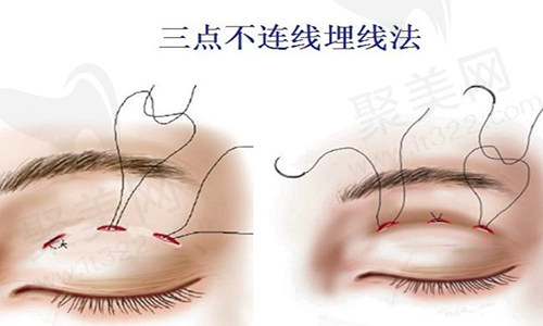 西安画美眼部整形