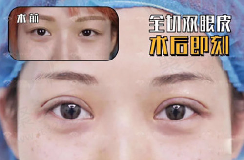 杜继凤双眼皮病例图片