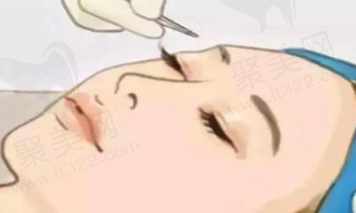 双眼皮整形
