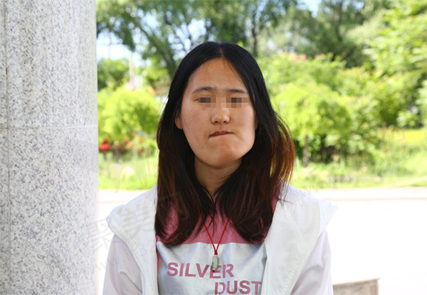 沈阳杏林整形医院歪脸女孩