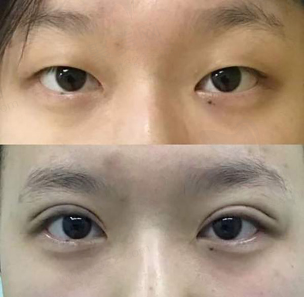 沈阳杏林整形外科医院双眼皮手术