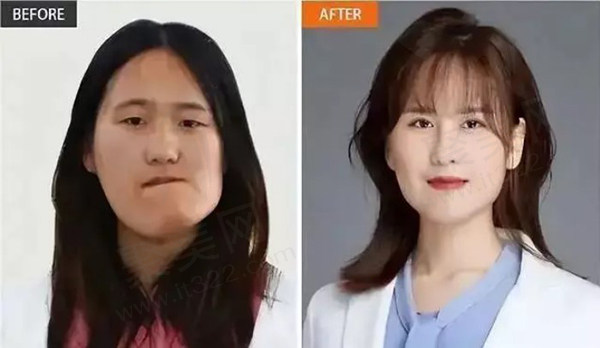 沈阳杏林整形医院歪脸女孩