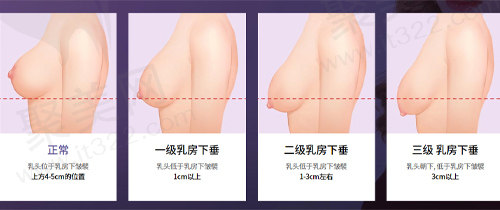 胸部下垂的分类