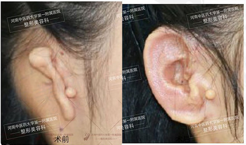 赵绛波耳畸形