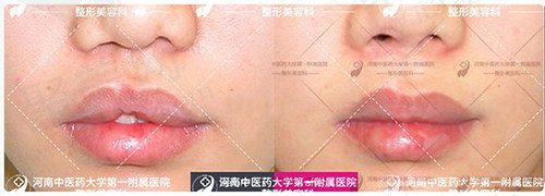 赵绛波唇腭裂修复