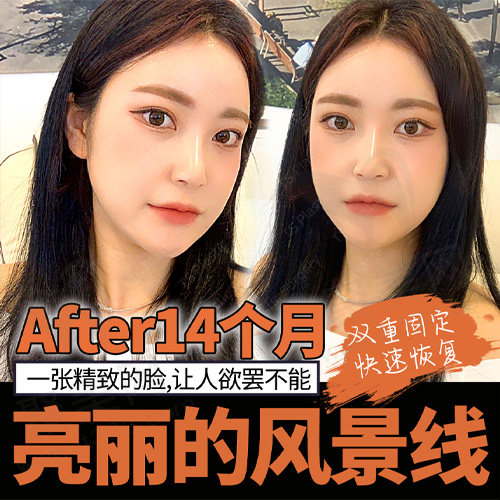 术后14个月的变化