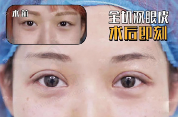 沈阳杏林做双眼皮哪个医生好