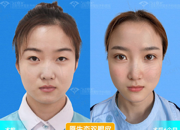 沈阳杏林做双眼皮哪个医生好