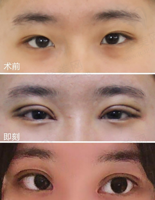 沈阳杏林整形外科双眼皮手术优势