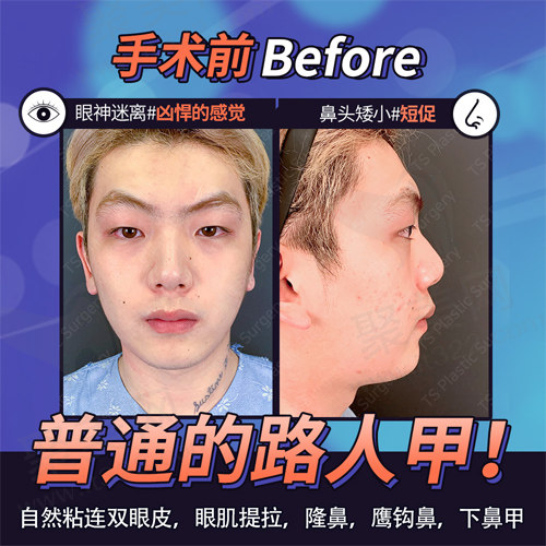 求美者术前外貌