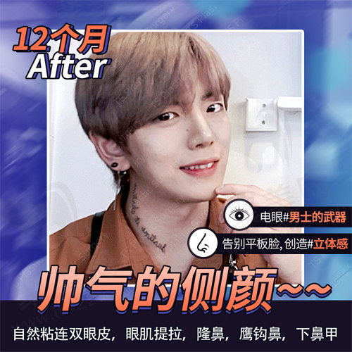 术后侧颜变化