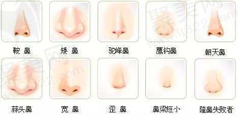 隆鼻