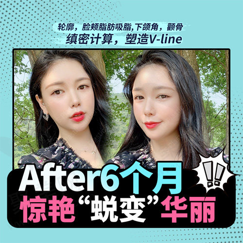 术后六个月华丽的变身
