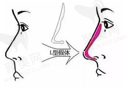 隆鼻假体