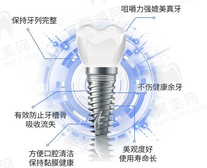 南京茀莱堡口腔医院做种植牙收费贵吗？