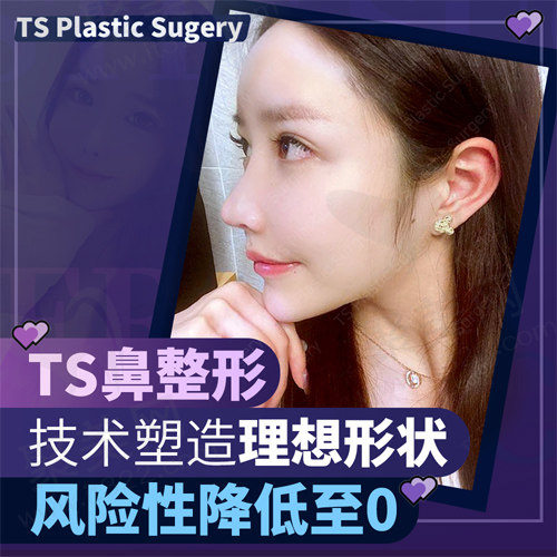 隆鼻后的状态