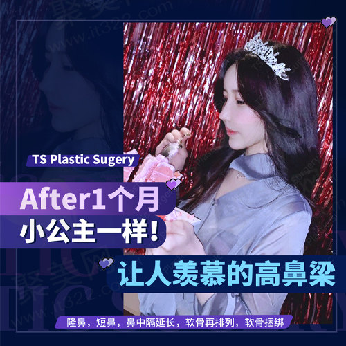 隆鼻手术后一个月