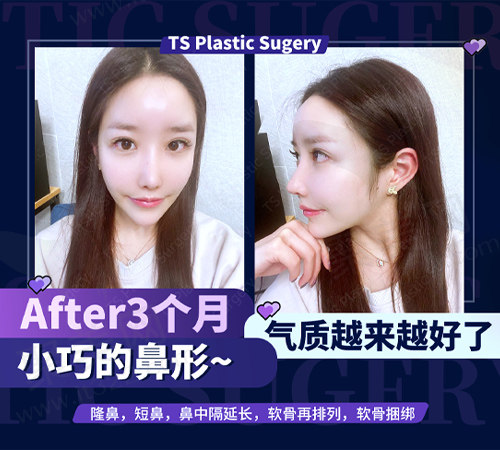 隆鼻手术后三个月