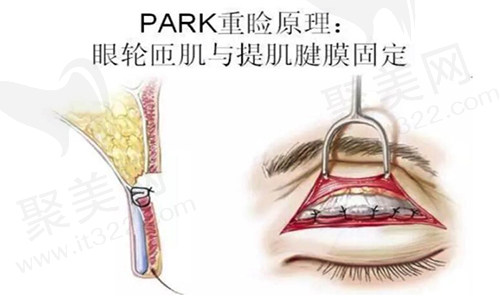 福州格莱美美容医院眼部整形