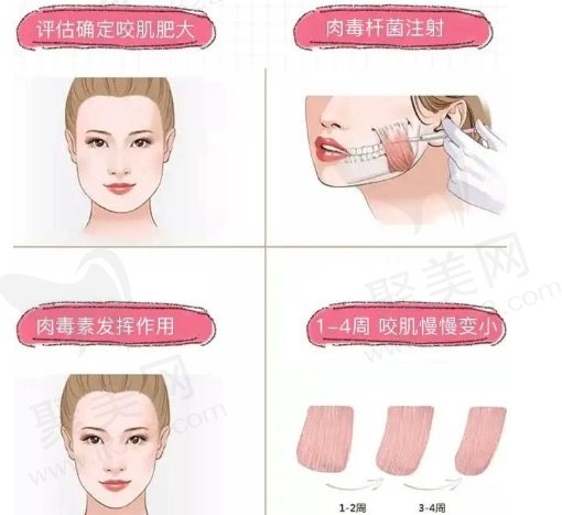 注射瘦脸