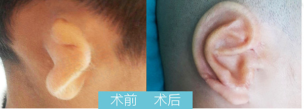 新生儿耳朵畸形是什么原因造成的呢