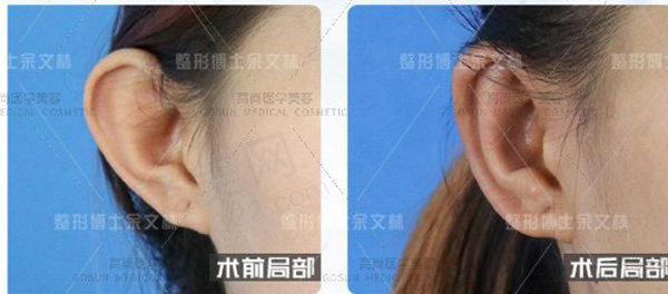 招风耳