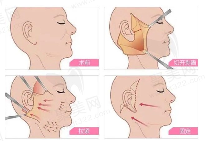 什么是小拉皮和大拉皮手术