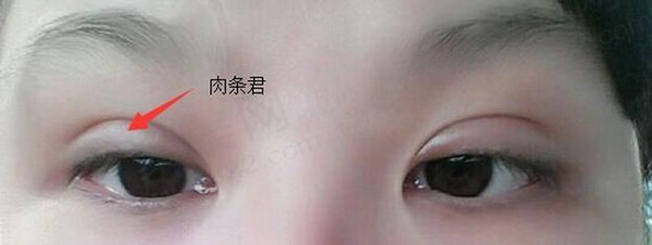 魏志香双眼皮修复