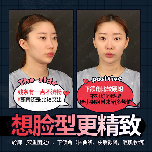 求美者术前样子