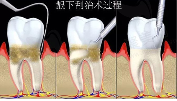 牙龈下刮治