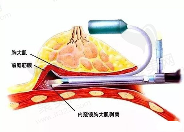 广州郝永生隆胸技术好