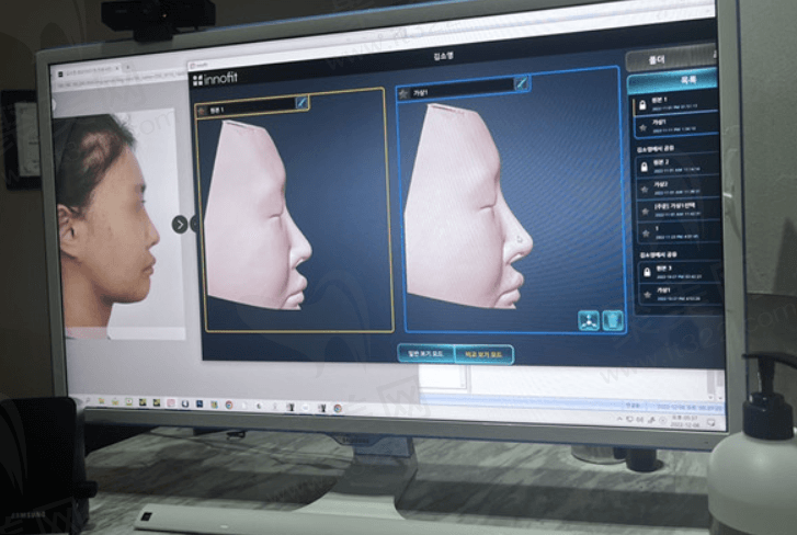 3D假体定制打印鼻