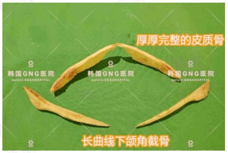 韩国GNG整形医院口碑好吗？