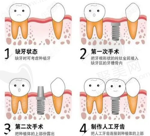 种植牙